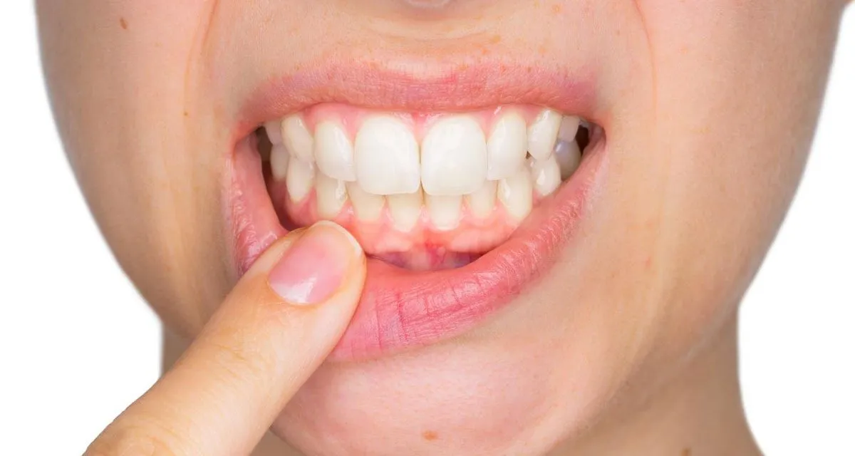Gum Disease Treatment